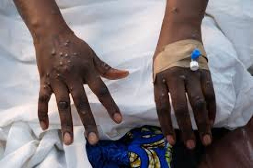 Togo : premier cas de Mpox confirmé par les autorités sanitaires